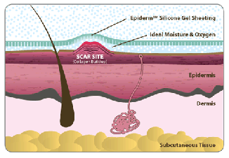 Epi-derm Illustration